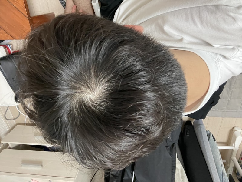early determination of hair loss