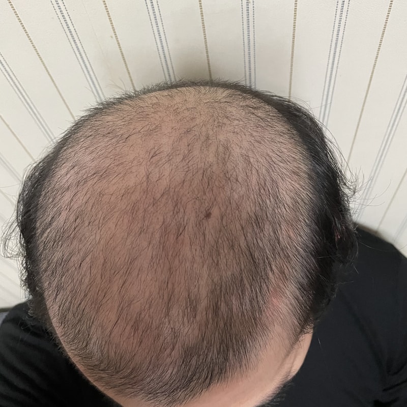 피나3개월 두타5개월 째 복용