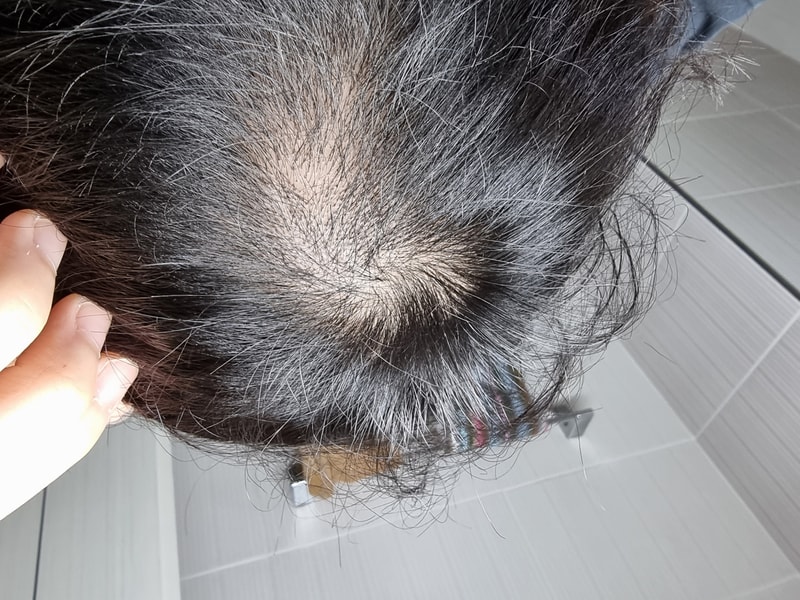 미녹시딜 2달차 좀 나아질 것 같나요