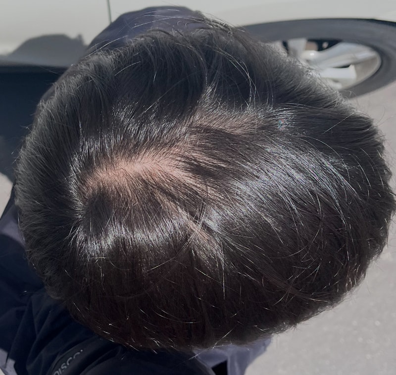 두타로 시작하는 탈모일기