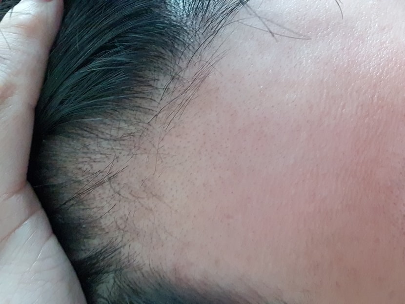 복용 전 ( 프로페시아 , 핀페시아 먹었다가 안먹었다 1년정도 반복 -이때 관리 꾸준히 했더라면..ㅠㅠ )