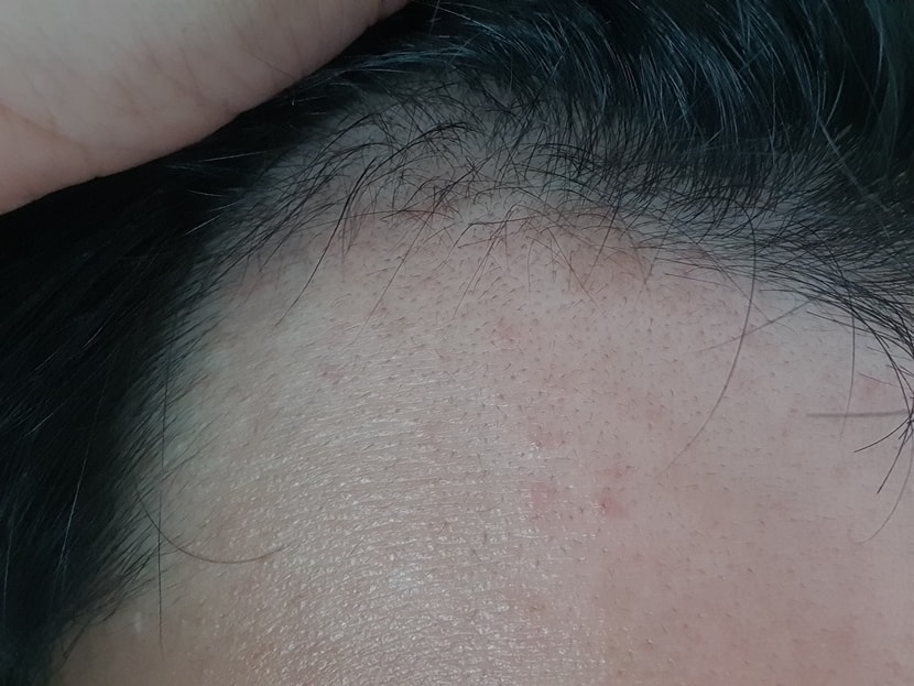 복용 2개월 후 ( + 맥주효모 , 오메가3 영양제 )