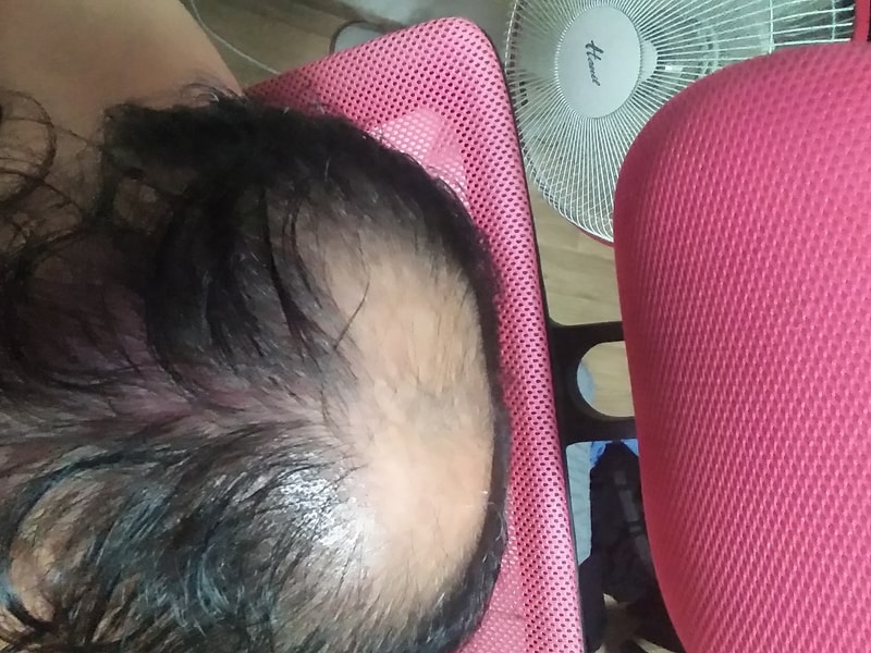 아보타트 카피약+미녹 7개월