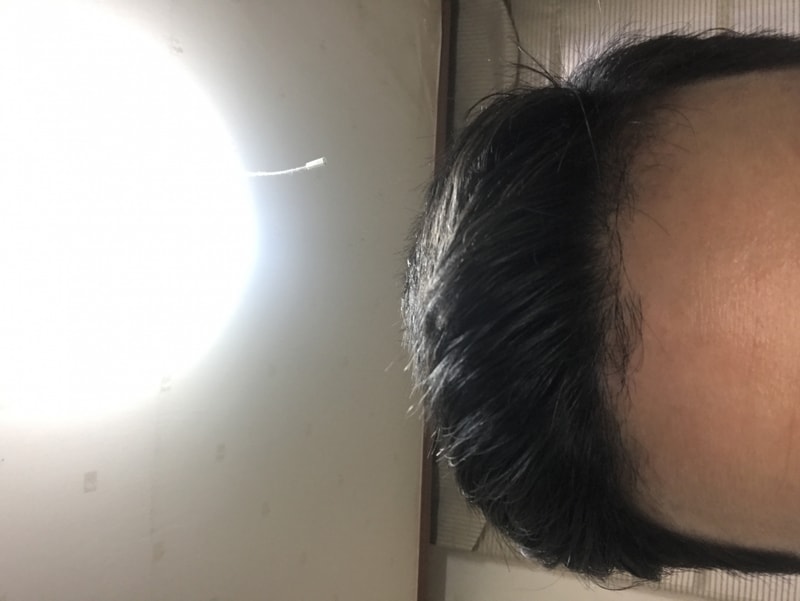 プロフェッシアで服用中の写真