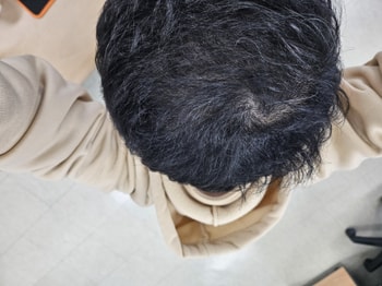 복용8개월중 체험단2개월 현재상태