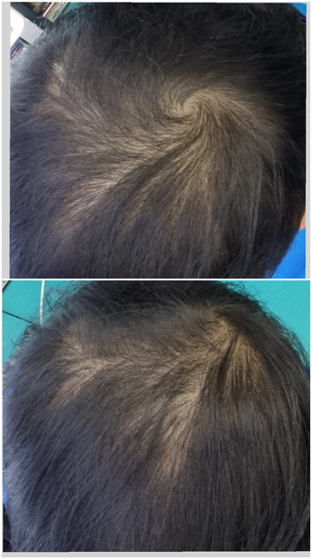 바르고 1개월차 쉐딩 오기시작할때 