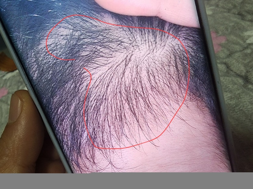 빨간 선 그려놓은 부위에 털이 완전연모화되서 없었는데 미녹시딜+피나먹고 나서 생겼습니다. 좋은 증상인가요. ? 