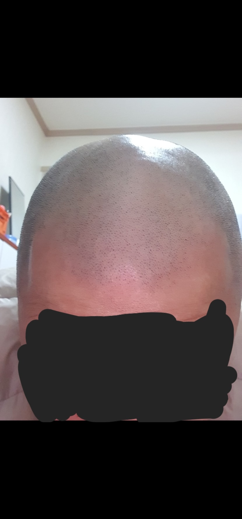 어 사진에 보니 빡빡이때 사진 있네여 이거 확대하셔서 모공 보시면 굵은 모발 모공은 거의 없는 상태인거 보이실거예여ㅋㅋ 저 머리스탈로.. 1년살았습니다..ㅜ 거울 볼때마다 분노조절이 와서...ㅋㅋ..엇. 빡빡이때 보니깐. 엠짜쪽에도 맨들맨들 수준이였군요..ㄷㄷㄷ