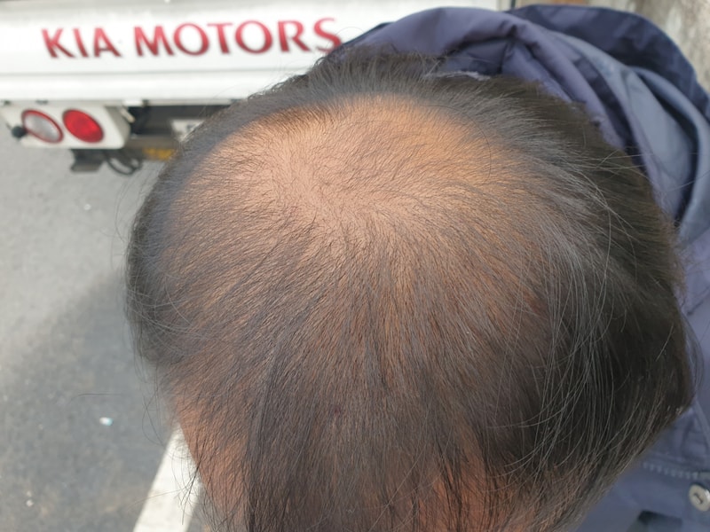 복합약 6개월 포토후기