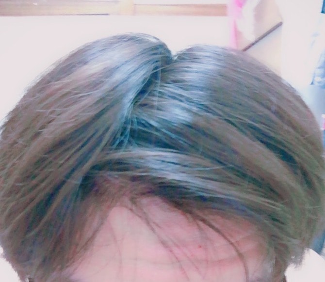 프페 복용 8개월째입니다