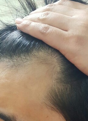 미녹시딜 4개월후반 두테스몰 2주일 후기