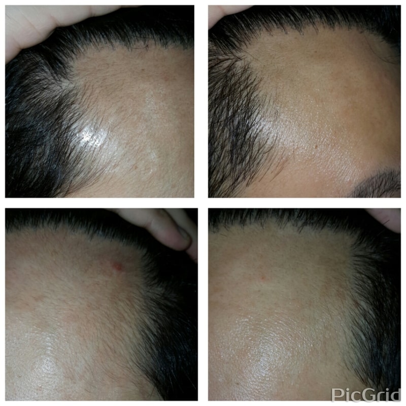 복합약 복용 74일차 입니다