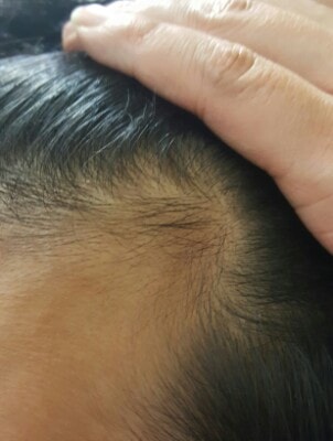 Minoxidil已经4个月了！！ Dootes Mall开始了！！