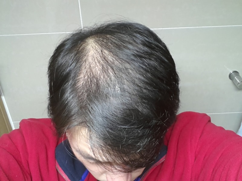 Abodat 1年+2个月后期