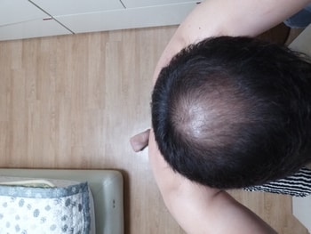 미녹 1달 12일 째 