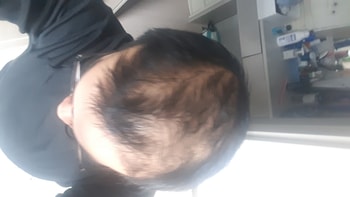 미녹시딜 시작전