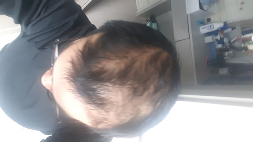 미녹시딜 시작전