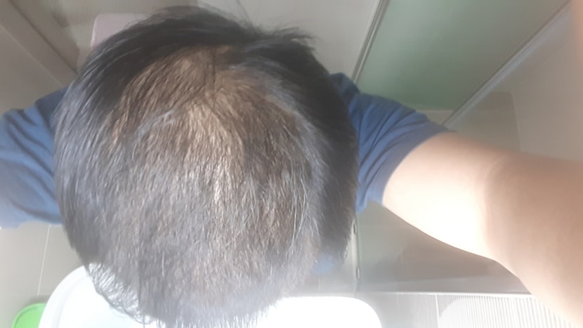 미녹 3달 프페 1달