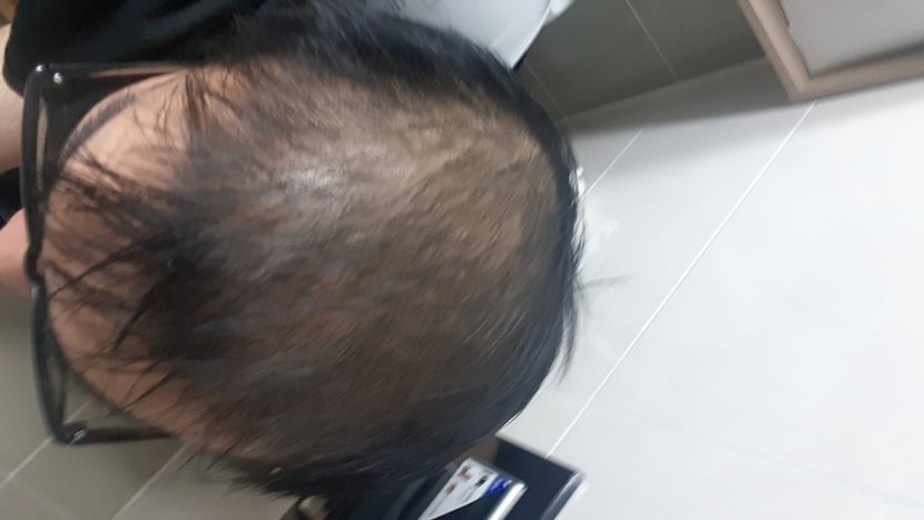 미녹 2달 프페 복용시작