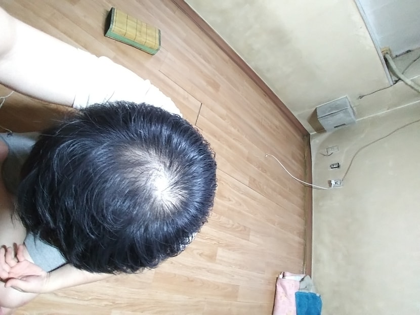 피나먹은지 딱 1년..앞머리랑 전두부는 좋아졌지만 정수리는 엄청 훼함 ㅠㅠ