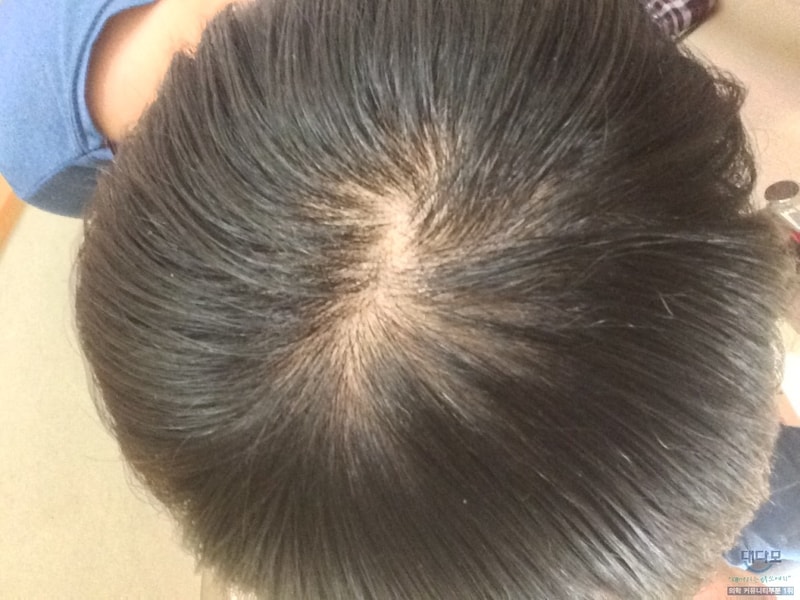 프로페시아 37일차...