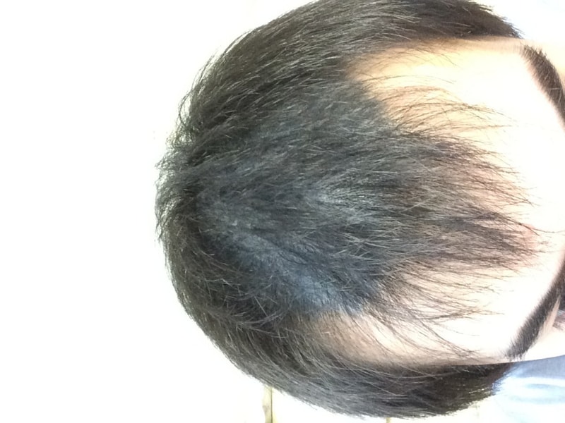 아보다트 복용 시작 합니다ㅠ 드디어 ㅠ