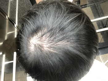 탈모약 복용전 엘리베이터 조명이 강합니다 (첫번째 사진보다 이전 머리자르기전)