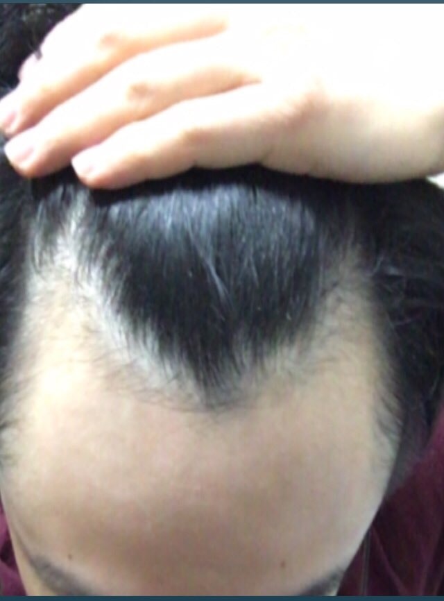 Propecia Minoxidil 2 Months and 2 Weeks Late