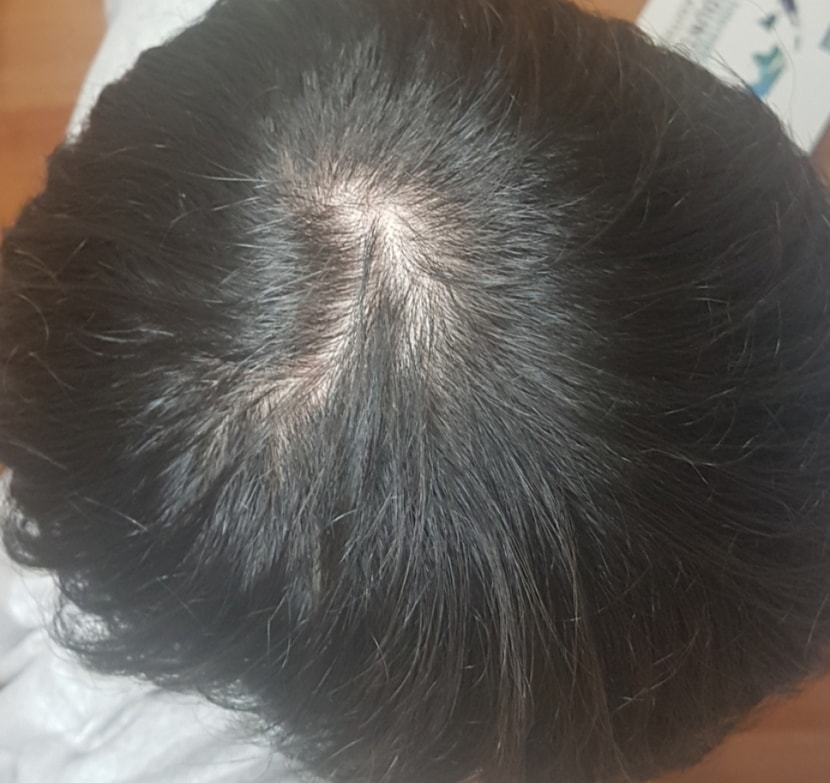 10월 피나 3개월차 사진입니다