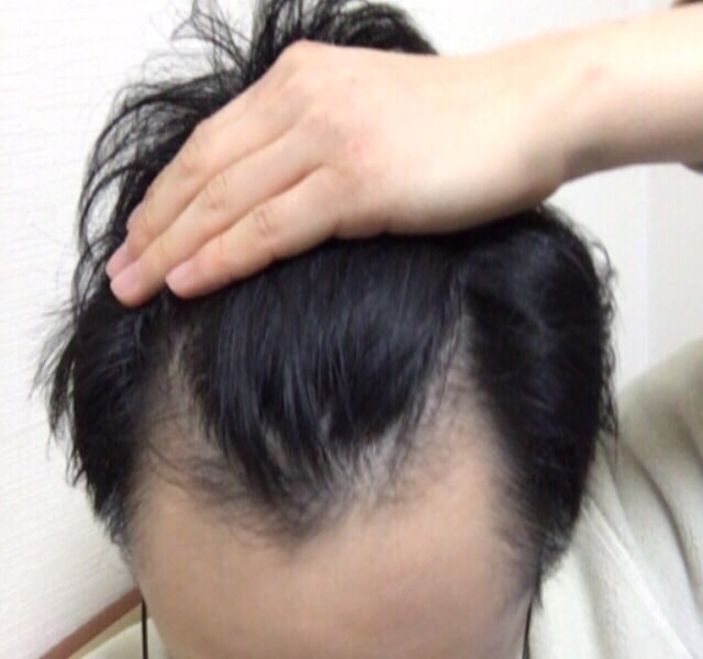 Propecia正品+现代Myloxil 4个月总后期（最后后期）