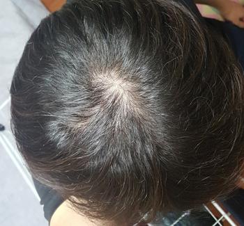 이게 약 먹은지 얼마 안됐을때의 정수리 사진입니다. 조명 바로 아래서 찍은 사진이고, 넓게 퍼져있는 탈모의 조짐을 확인하실 수 있습니다!! 이당시에 진짜 탈모에 대한 두려움이 너무 심해서 밖에도 잘 못나갔었네요...