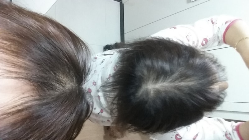 4개월20일 프카치료