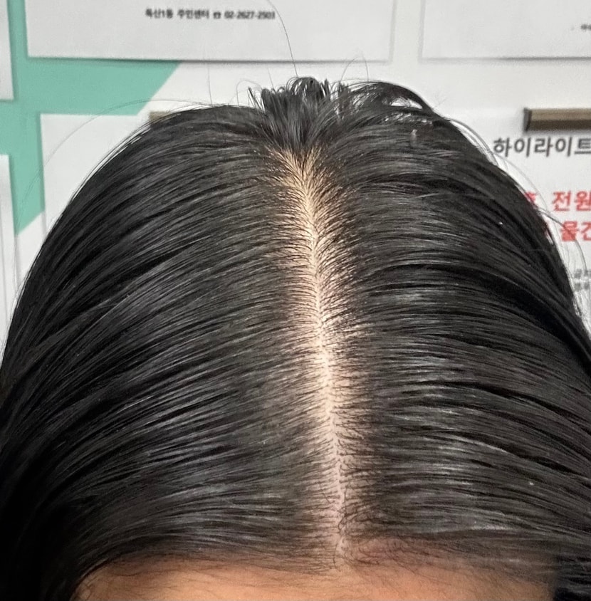 치료 7개월차