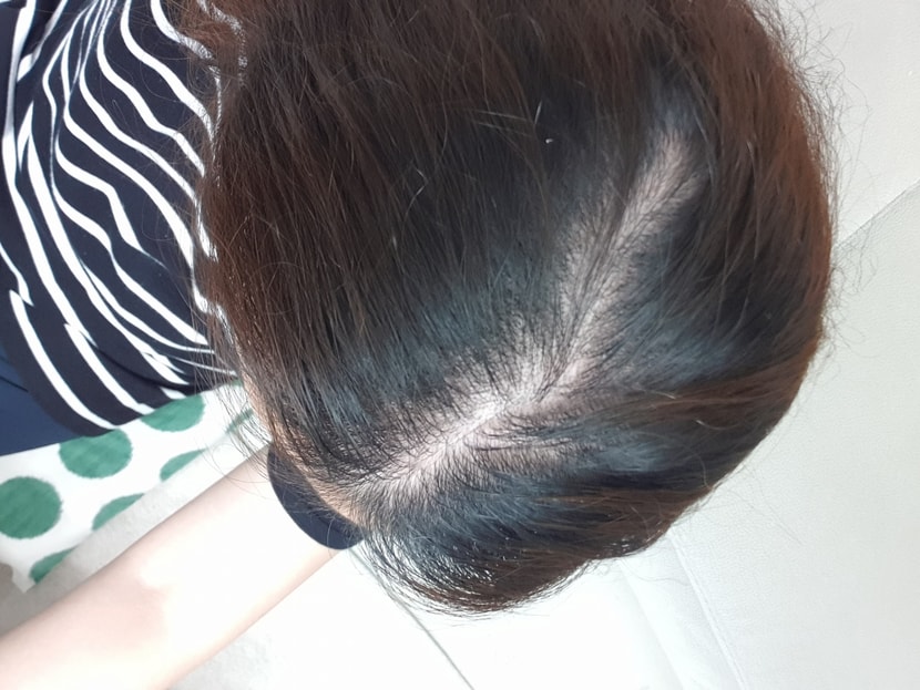 쉐딩 정수리