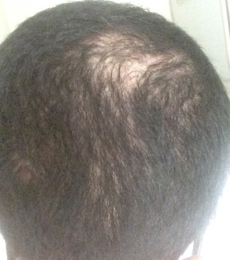 프페3개월 피나테드 2개월..