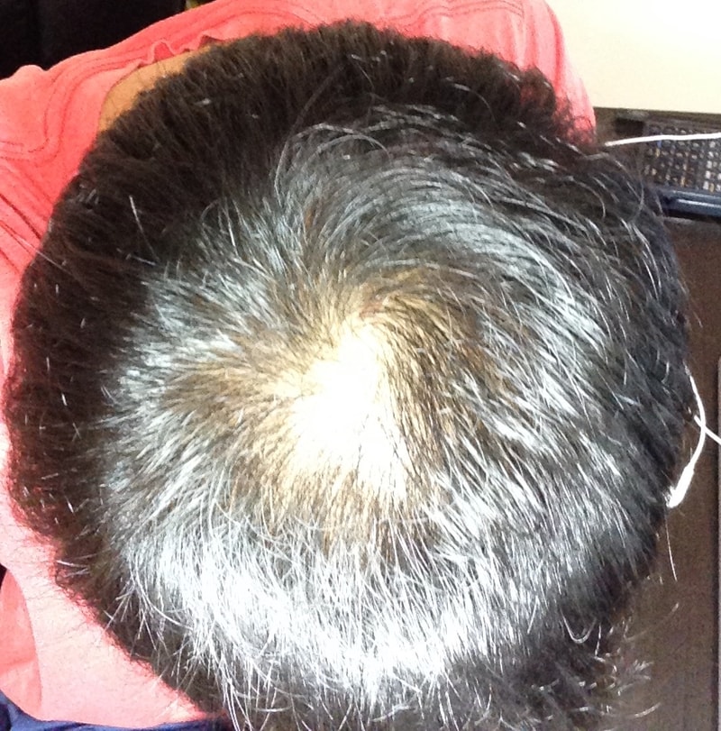 服用Propecia的一个月后期。