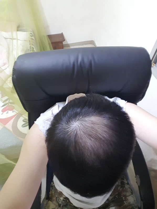 프로페시아 시작전