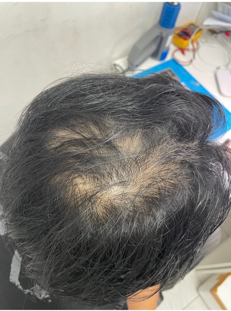탈모약 먹기 전