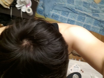9월 30일 마이녹실 도포 후