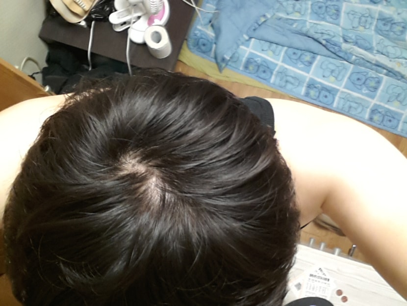 9월 30일 마이녹실 도포 전