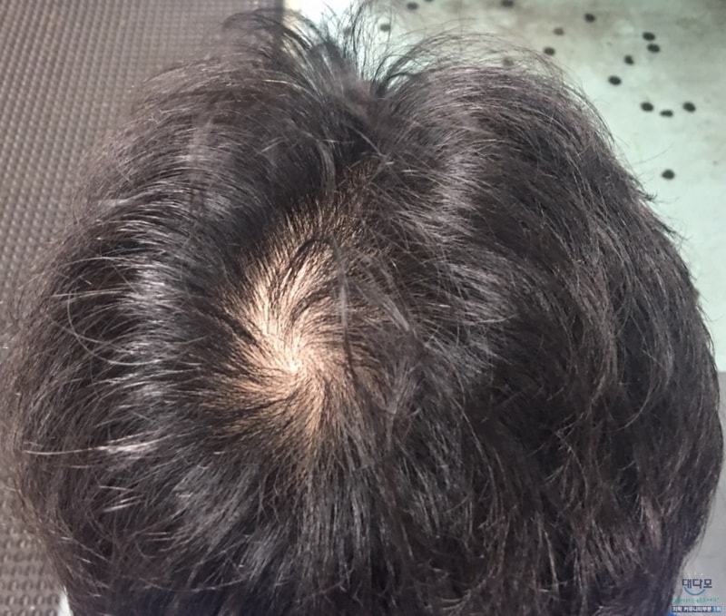 After 7 months of hair loss treatment (Profecia 6 months, 2 weeks, and 2 weeks of adot)