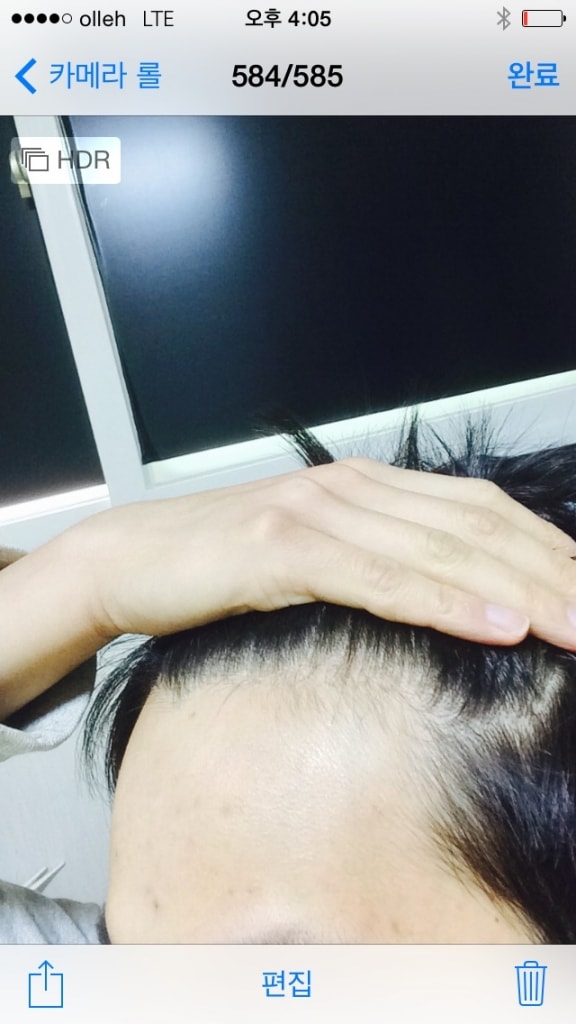 아보다트 1개월 반 복용후 후기