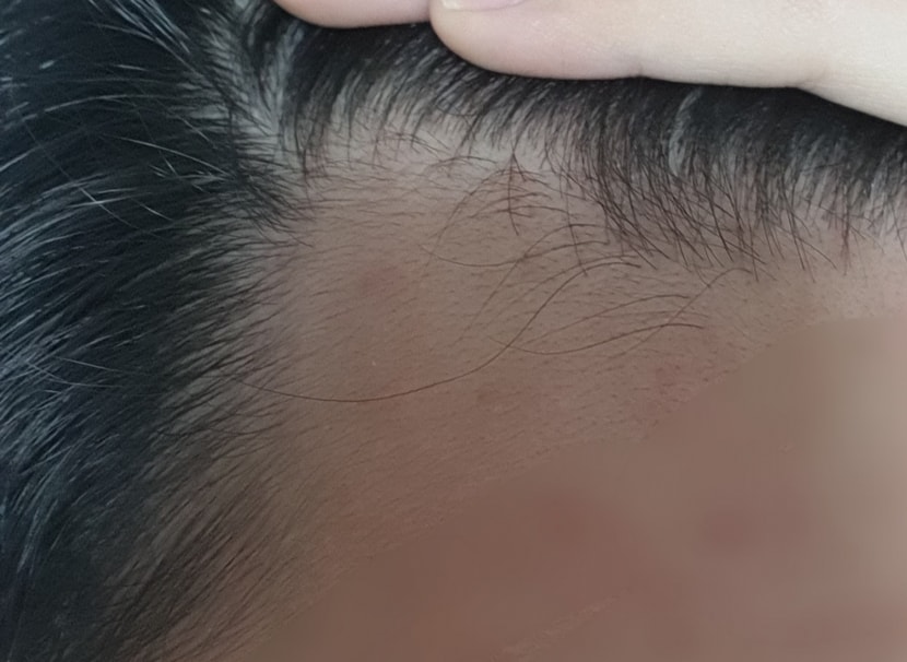 미녹 시작 전