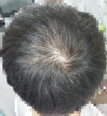 M자 탈모는 아닌줄 알았으나 정수리보다 잔머리 자라는게 보이는 사진 ㅜㅜ