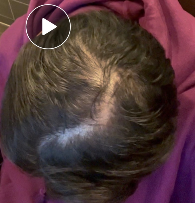 I applied Minoxidil for 2 years and took it