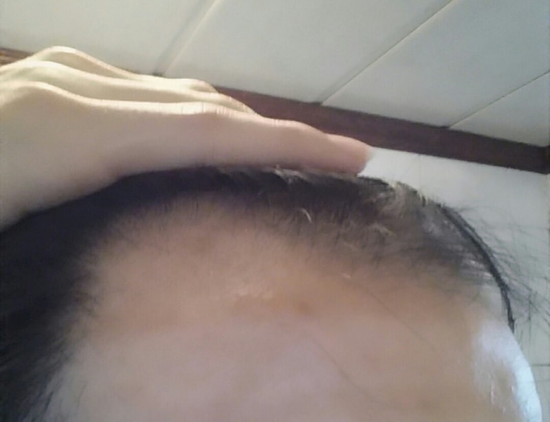 美肌修护精华露 2个月 美肌修护精华露 1个月后期