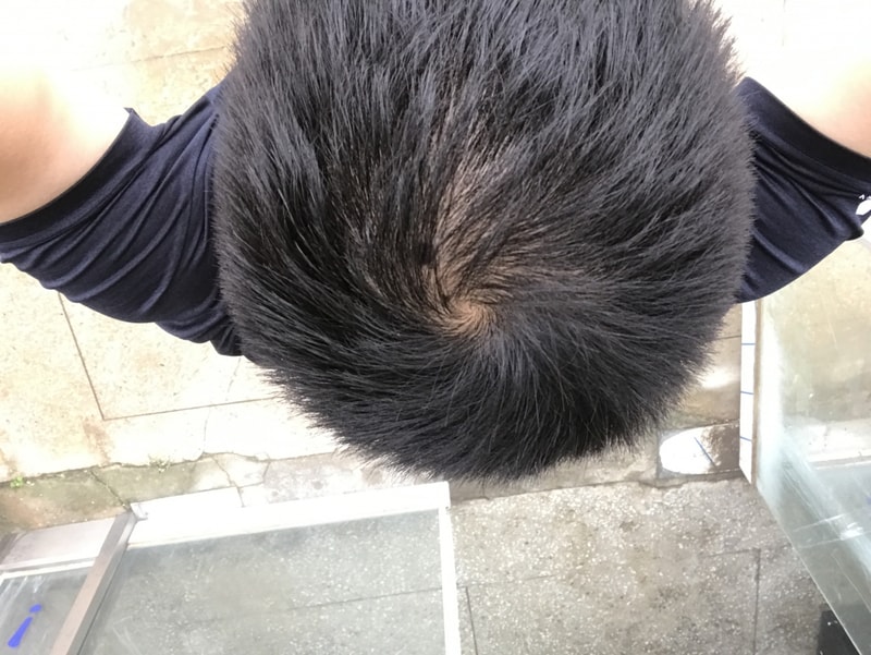 因脱发而受苦的军人。 今天是流血的第50天！