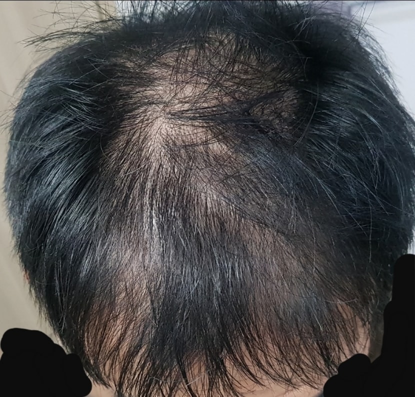 복용 1일차 사진 