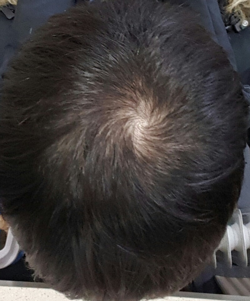 피나스타 8개월 프로스카 1개월 어때보이나요??