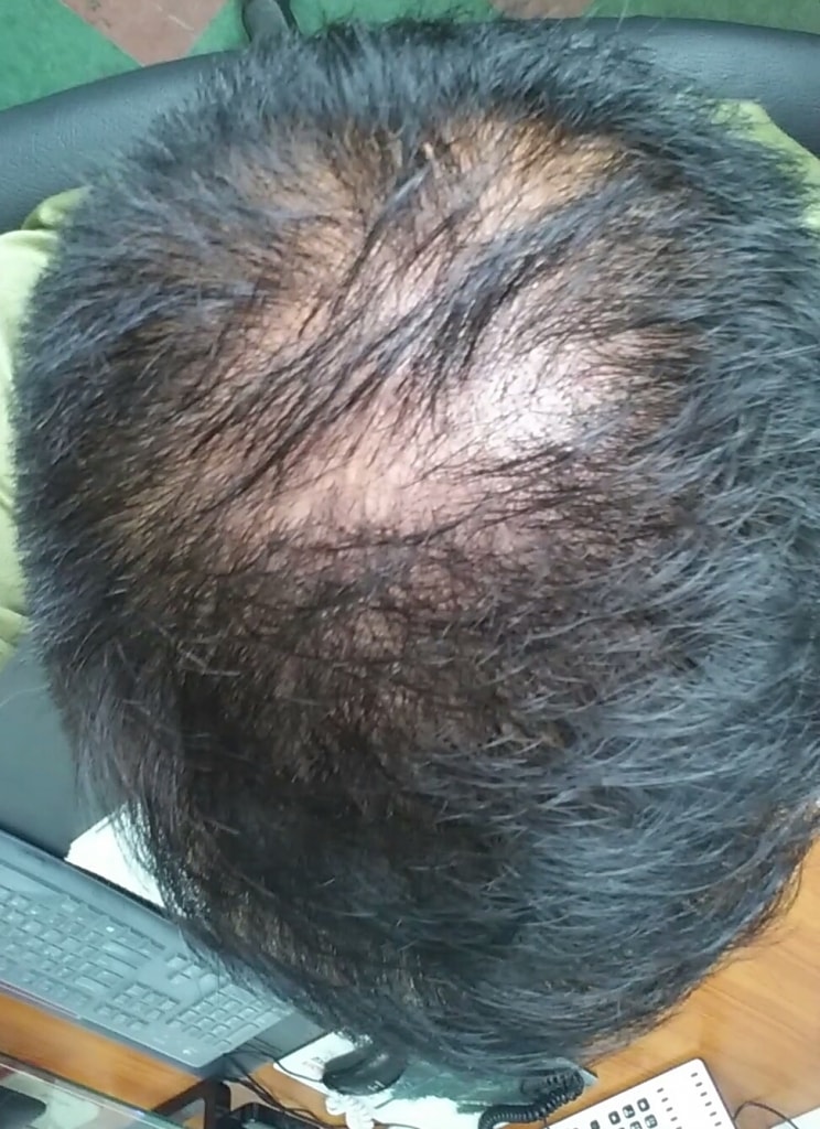 20개월 복용 후기(15년 6월 ~ 현재)